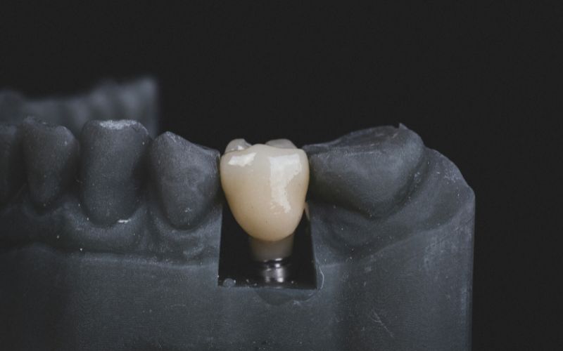 Does Medicaid Cover Dental Implants